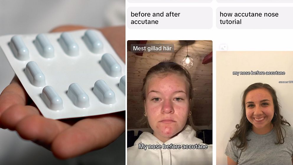På sociala medieplattformen Tiktok påstår användare att deras näsa krympt efter att de tagit den starka aknemedicinen Isotretinoin, även kallat Roccutane eller Accutane.