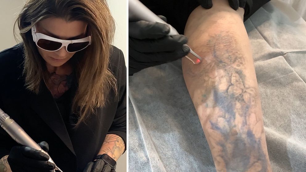 Marleen Silvernacke tar bort tatuering med hjälp av en laser