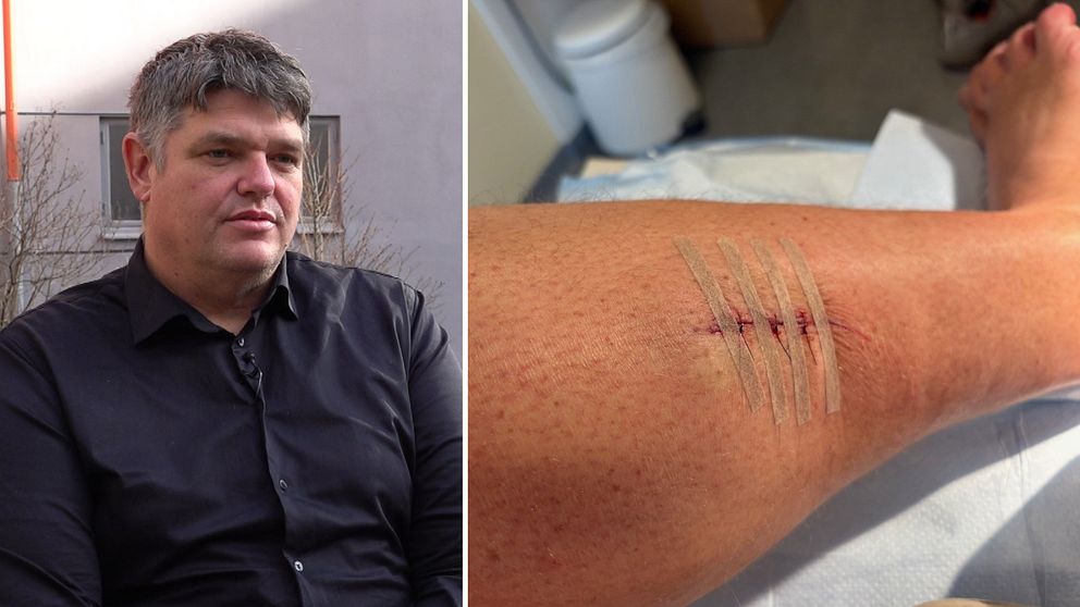 Tvådelad bild. Vänster: man i mörk skjorta. Höger: skadad ben med sår och plåster, skador efter en vildsvinsattack