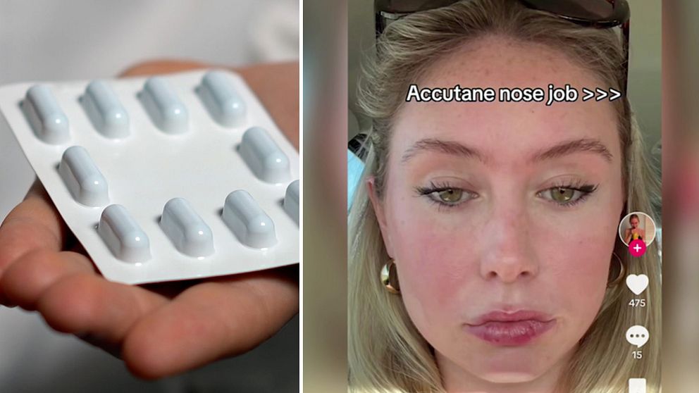 På sociala medieplattformen Tiktok påstår användare att deras näsa krympt efter att de tagit den starka aknemedicinen Isotretinoin, även kallat Roccutane eller Accutane.