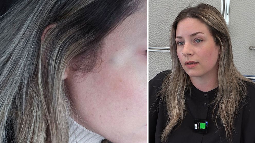 Sussi Martens fick ett blåmärke efter botox