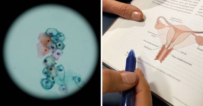 Studio: il vaccino HPV riduce il rischio di cancro cervicale