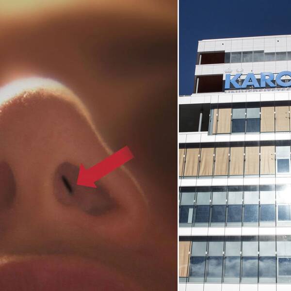 En av de opererade näsorna, samt Karolinska sjukhuset i Solna