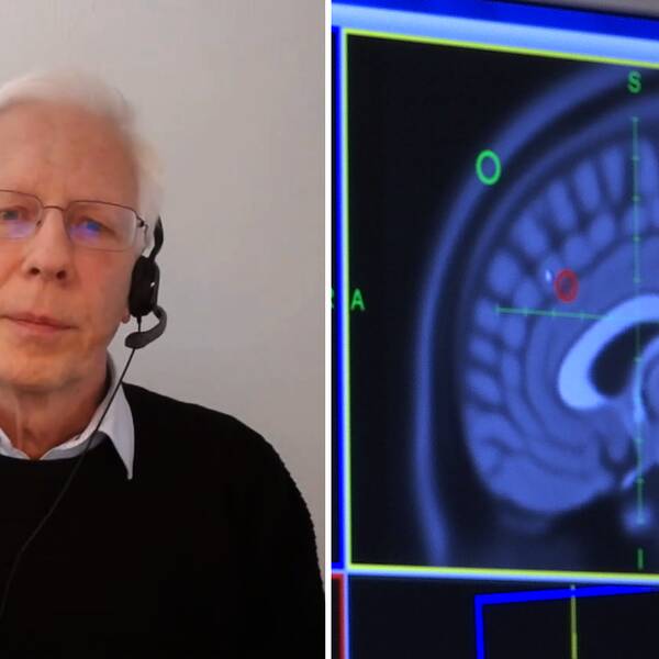Tvådelad bild: Gunnar Hägglund, professor i barnortopedi under ett videosamtal, samt en hjärna sedd i en skärm till en magnetröntgen.