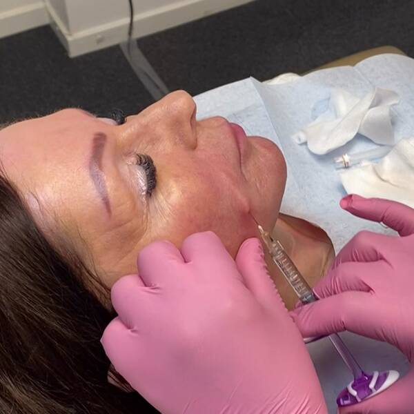 en injek,tionsbehandling i ansiktet med en nål i huden