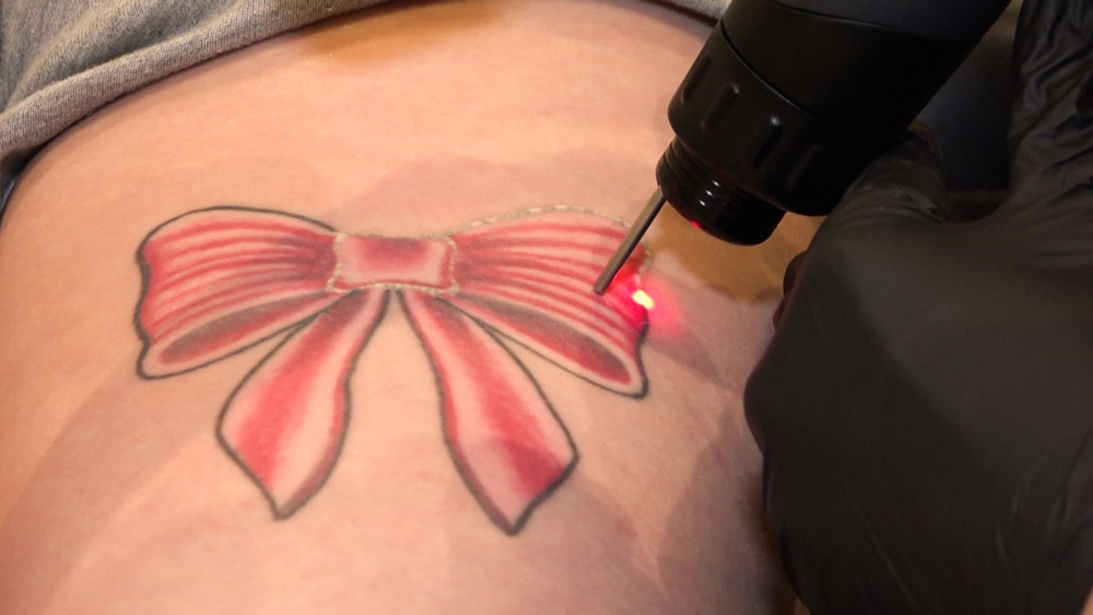 Tatueringen ska bort