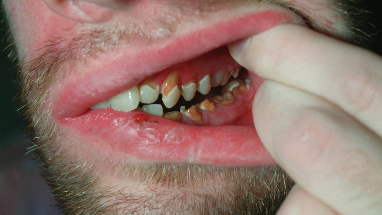 papillomavirus i munnen