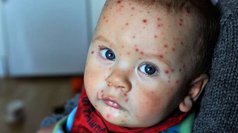 Rusning Efter Vaccin Mot Vattkoppor Svt Nyheter