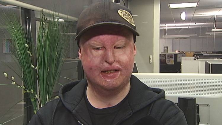 Släckt kalk frätande?