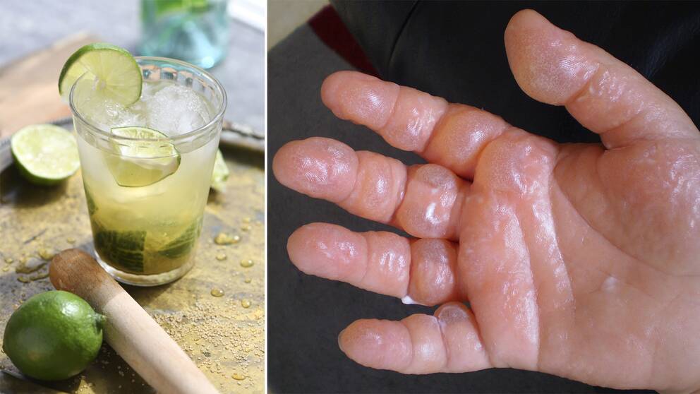 Drinken caipirinha med lime, råsocker, cachaça eller ljus rom och is. Hand med phytophotodermatitis.