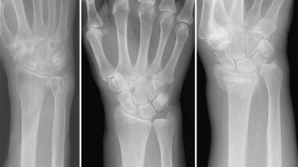 Röntgenbild som visar tre bilder varav en har en allvarlig fraktur.