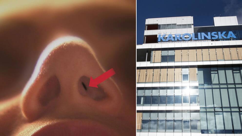 En av de opererade näsorna, samt Karolinska sjukhuset i Solna
