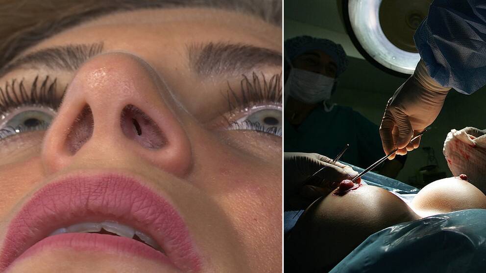 Till vänster en patient med misslyckad näsoperation. Gabriella Kaya lever med en ständig känsla av att kvävas. Efter två misslyckade näsoperationer på en privat klinik är hålen inne i hennes näsa bara några millimeter stora. Hon blev lovad en operation som skulle vidga hennes luftvägar på Karolinska universitetssjukhuset, men nu har sjukhuset fattat ett policybeslut att inte hjälpa skönhetsopererade patienter. // Till höger en bröstoperation i Venezuela. FILE – In this Jan. 22, 2007 file photo, a plastic surgeon performs breast implant surgery in Caracas, Venezuela. Venezuela is offering free surgeries for women to remove faulty French-made breast implants, the country's top health official said on Tuesday Dec. 27, 2011. France's health system has recommended that women with the PIP implants get them replaced, and has agreed to pay for surgeries. In Brazil and Argentina, however, health officials just recommend checkups. (AP Photo/Leslie Mazoch, File) // Om materialet PIP: De franska implantaten Poly Implant Prothese (PIP) såldes till omkring 300.000 kvinnor världen över innan det avslöjades att implantaten innehöll en typ av silikon som inte var godkänd. Implantaten kan lättare spricka med risk för att silikonet sprider sig i kroppen med svåra hälsoproblem som följd.