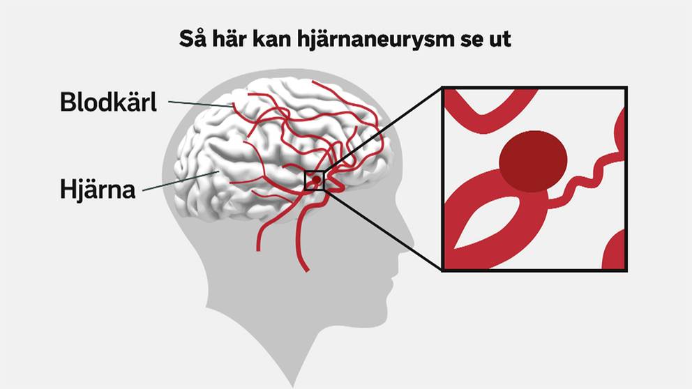 peruk blodig hjärna main image 0