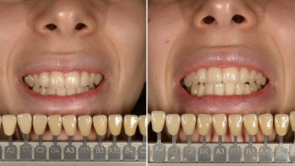 Nytt Material Ska Ge Snyggare Och Starkare Tandproteser Svt Nyheter