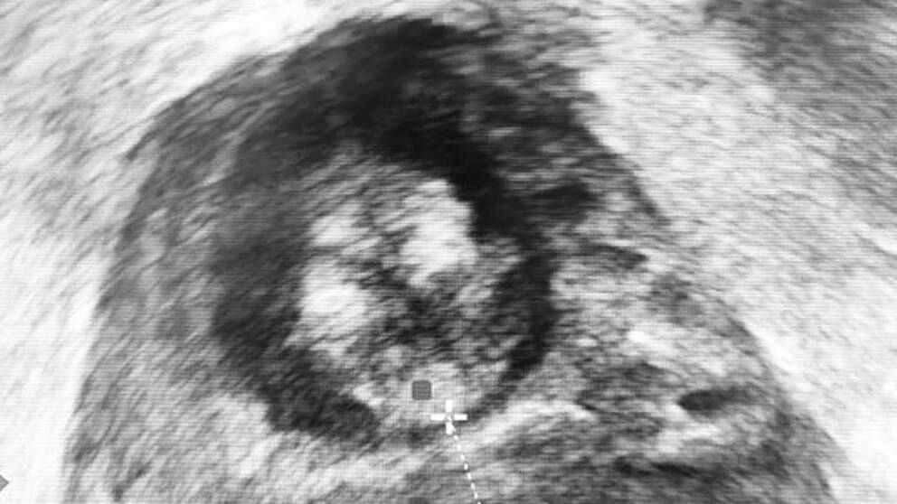 Ultraljudsbild av inre trasig slutmuskel i ändtarmen