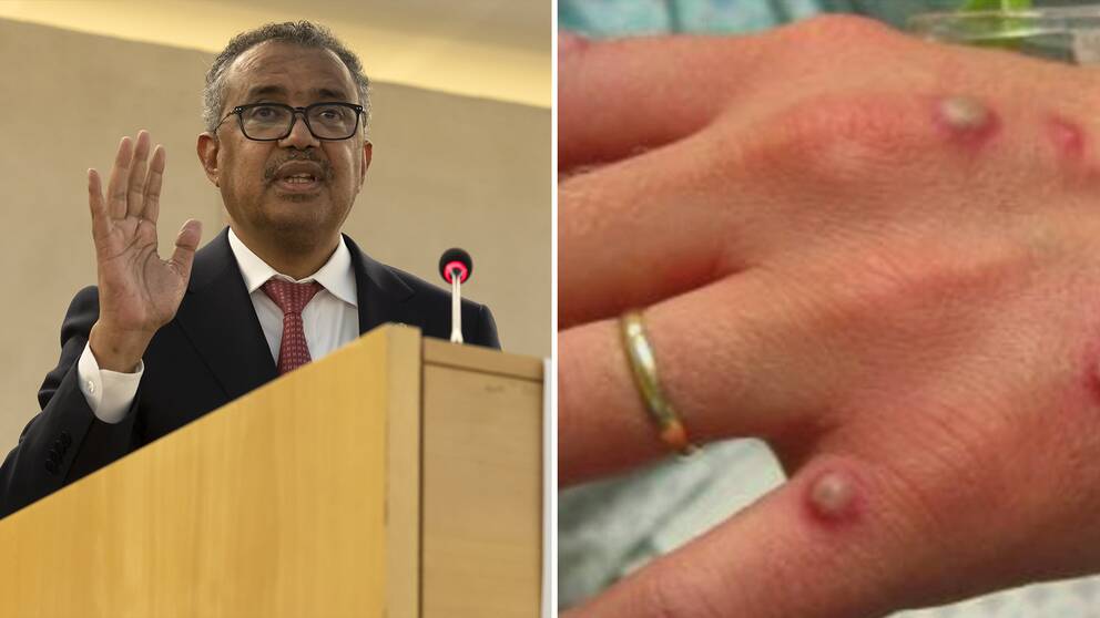 Bildföreställande WHO:s generaldirektör Tedros Adhanom Ghebreyesus och en hand tillhörande en person som insjuknat i apkoppor.