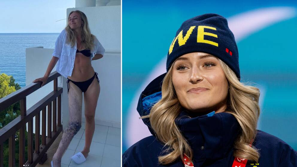 Parastjärnan Ebba Årsjö visar upp sitt ben på sociala medier. Hör henne berätta om varför hon nu väljer att visa upp det.