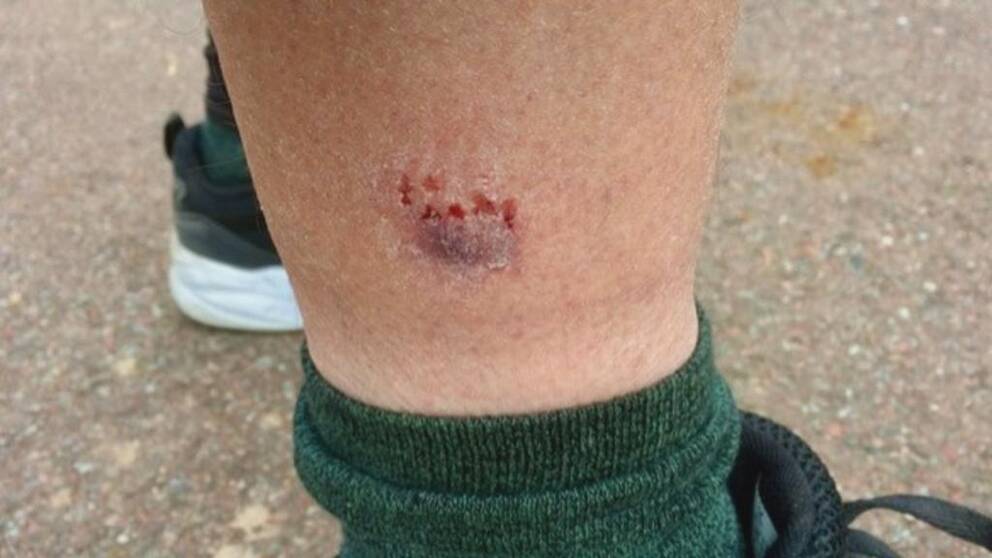 Bild på smalben med ett sår efter en hundattack