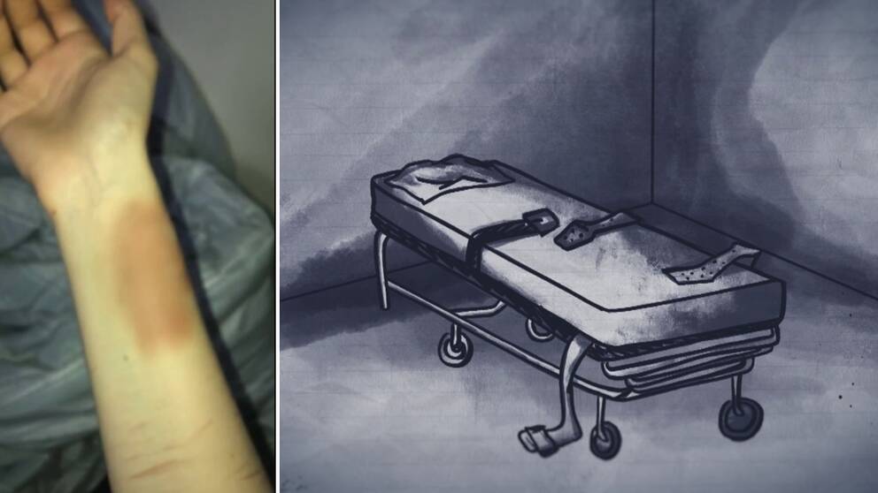 Arm med blåmärken efter bältning, bältessäng.