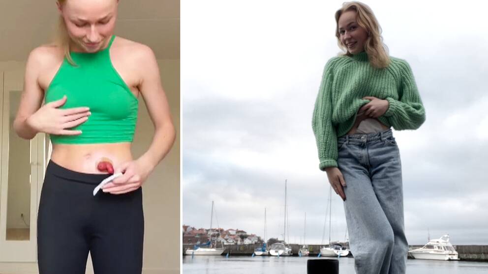 Julia Nilsson från Boden visar upp sin mage både utan och med stomipåse.