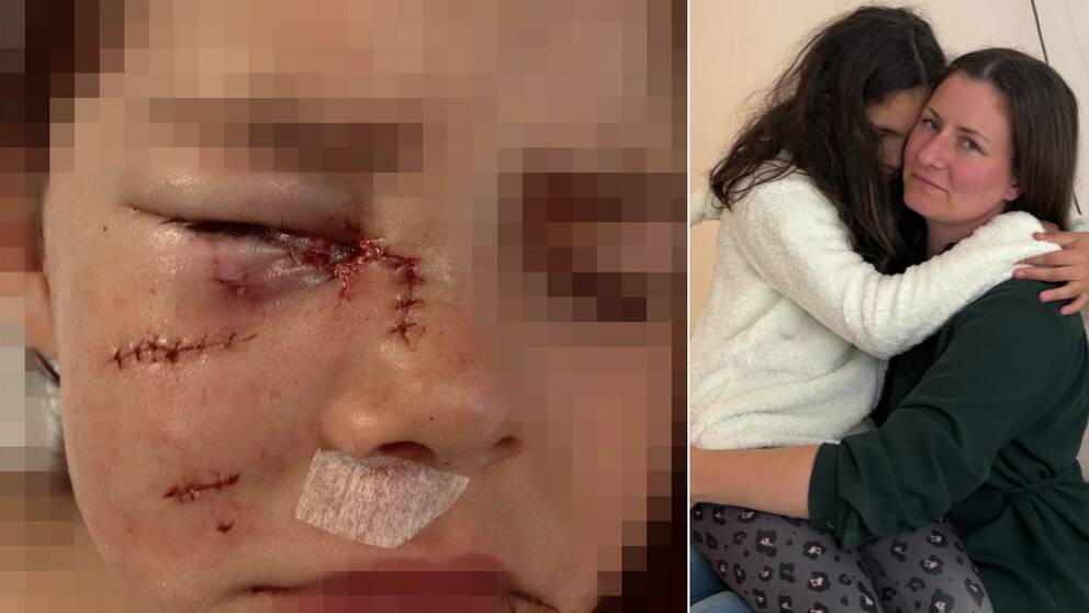 Till vänster: Närbild på Umeåbon Sara Bergmarks dotters ansikte, som är svullet och har flera sydda sår efter att ha attackerats av en hund. Till höger: Sara Bergmarks sitter och håller om sin dotter.