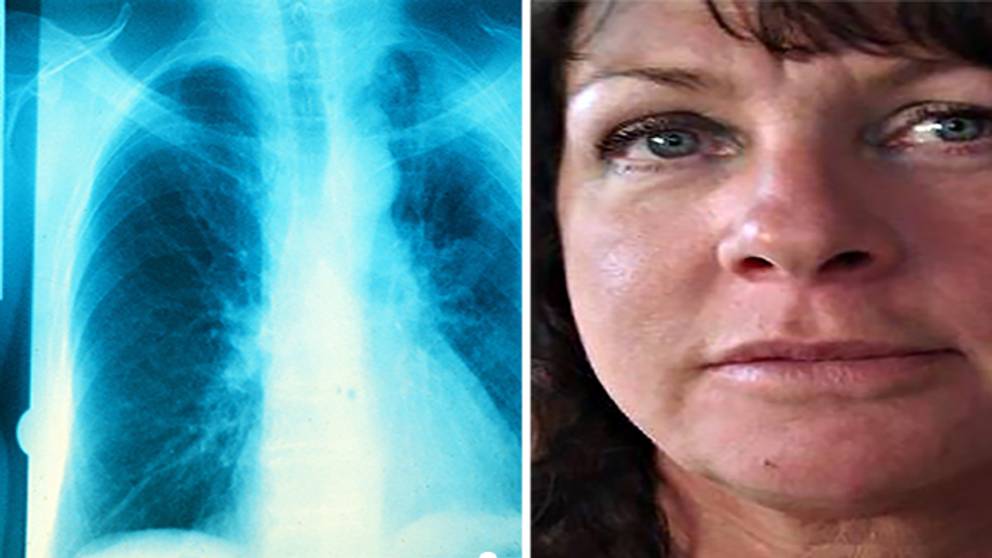 Läkare missade hennes knöl – var cancer | SVT Nyheter